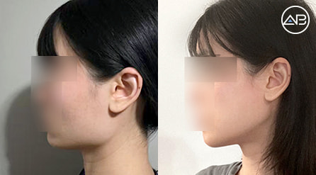 【下颌角缩小+下巴+劈外板】 术后8周【真实后记】