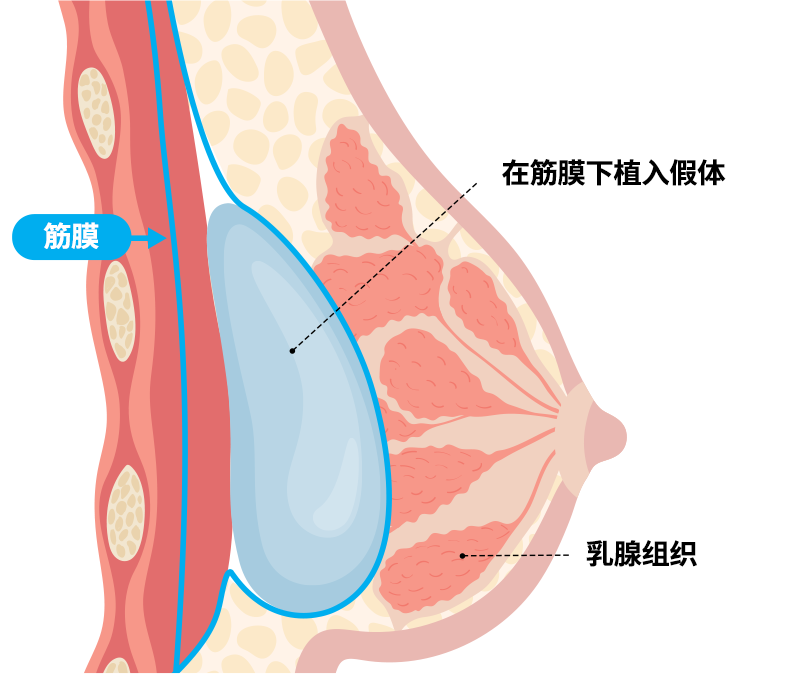 筋膜下插入法