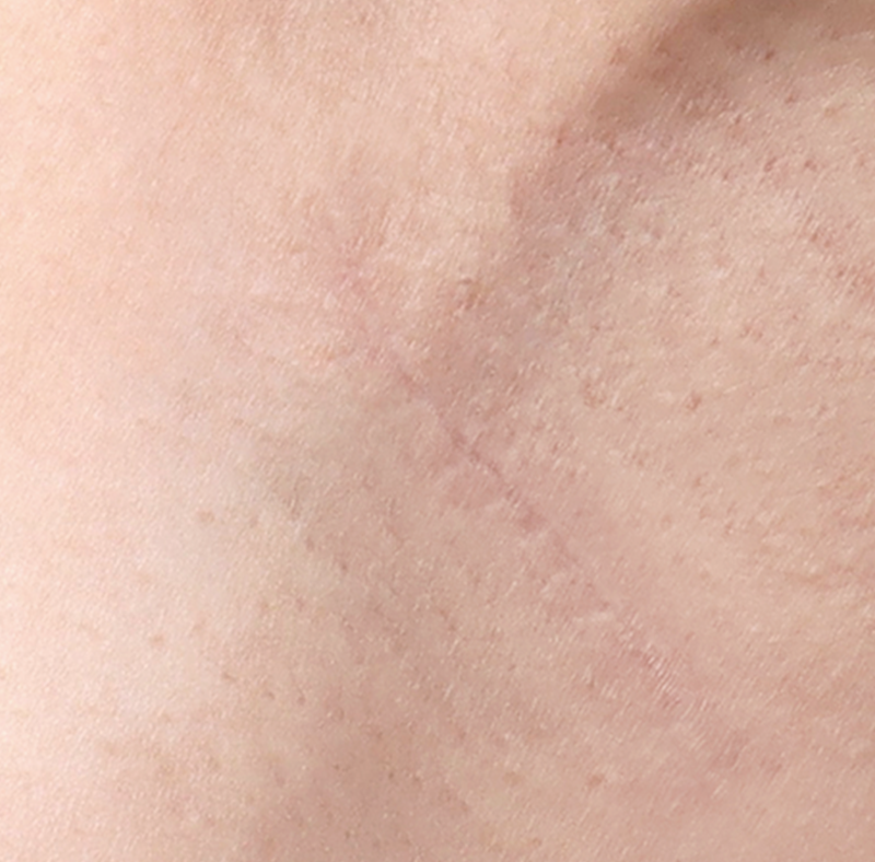 Minimal incision line