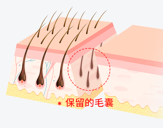 用45度斜线切开保留毛囊