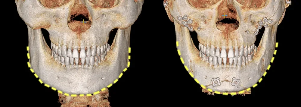 Facial contouring CT before and after 1