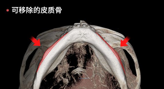 为获得正面效果切除皮质骨