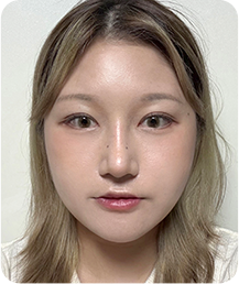 맥미걸 악플콜렉터 Before후 사진