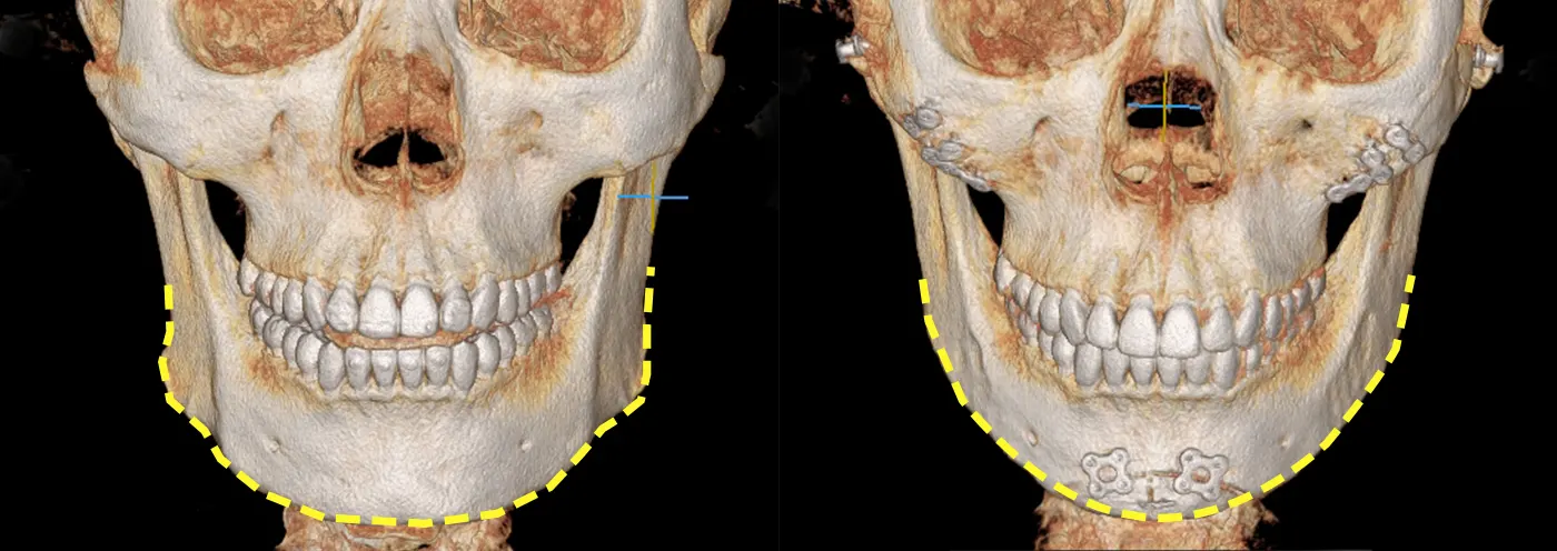 맥미걸 악플콜렉터 수술 전후 ct 사진