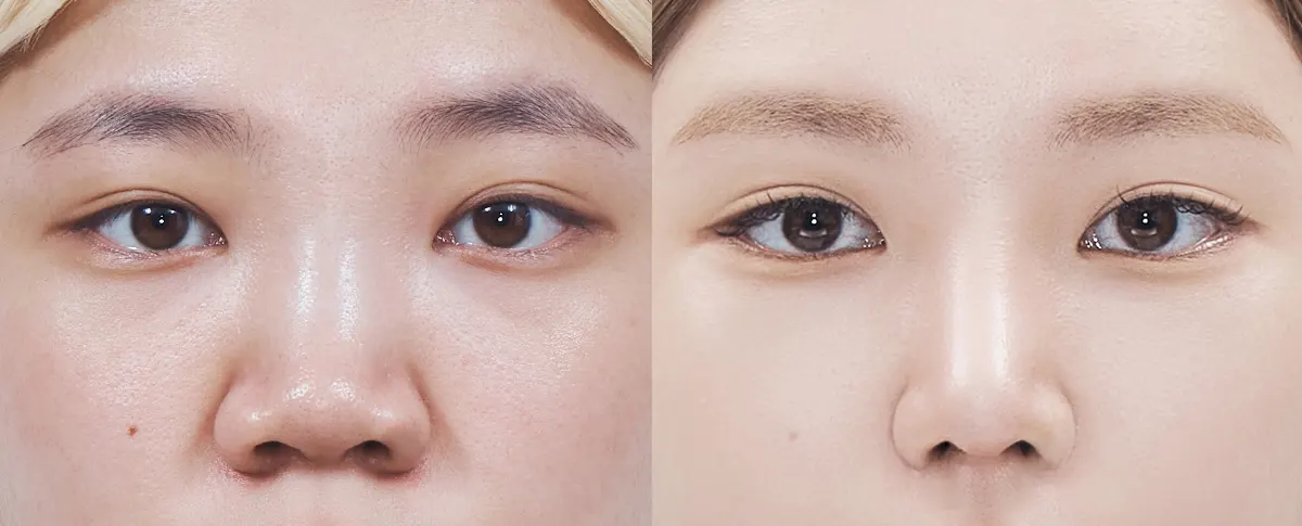 맥미걸 악플콜렉터 수술 전후 의학 사진