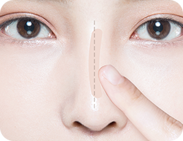 revision-rhinoplasty