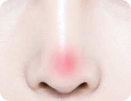 revision-rhinoplasty