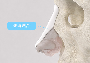 3D定制鼻整形,SOFIT