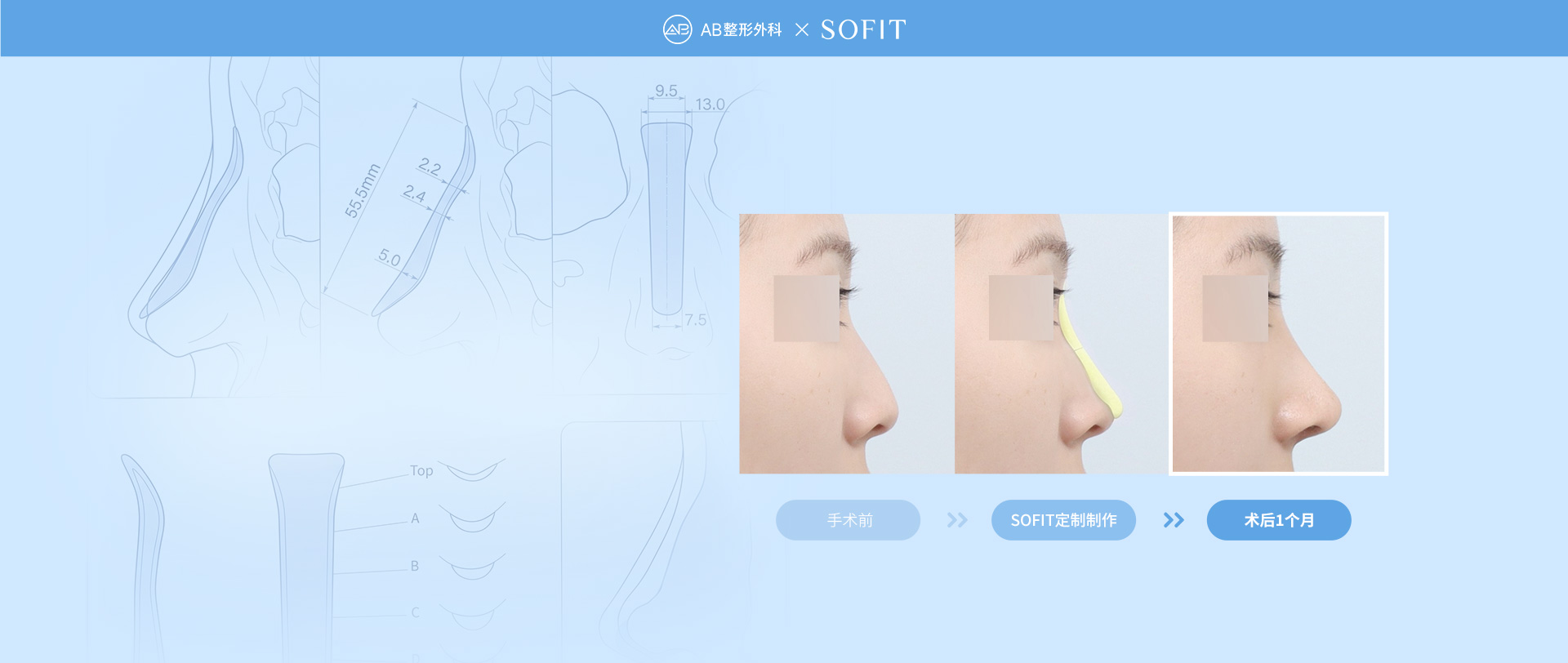 Sofit Nose