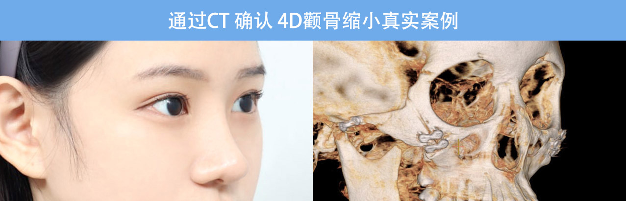 通过CT 确认 4D颧骨缩小真实案例 