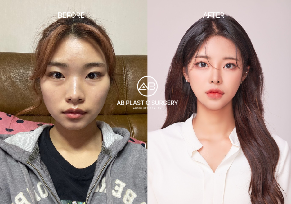 韩国整形外科，之前和之后