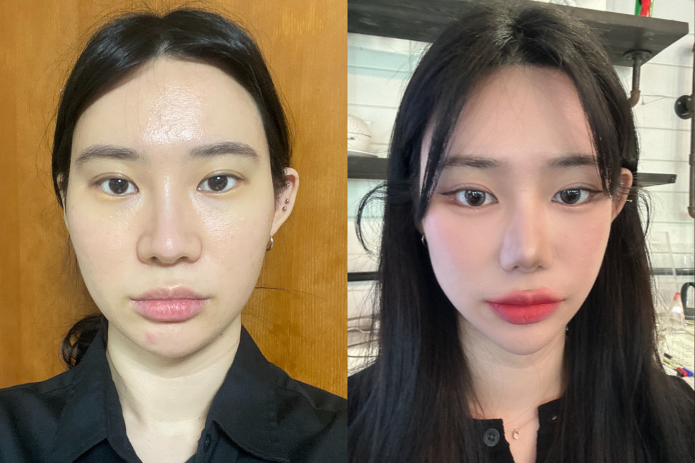 韩国鼻孔缩小手术