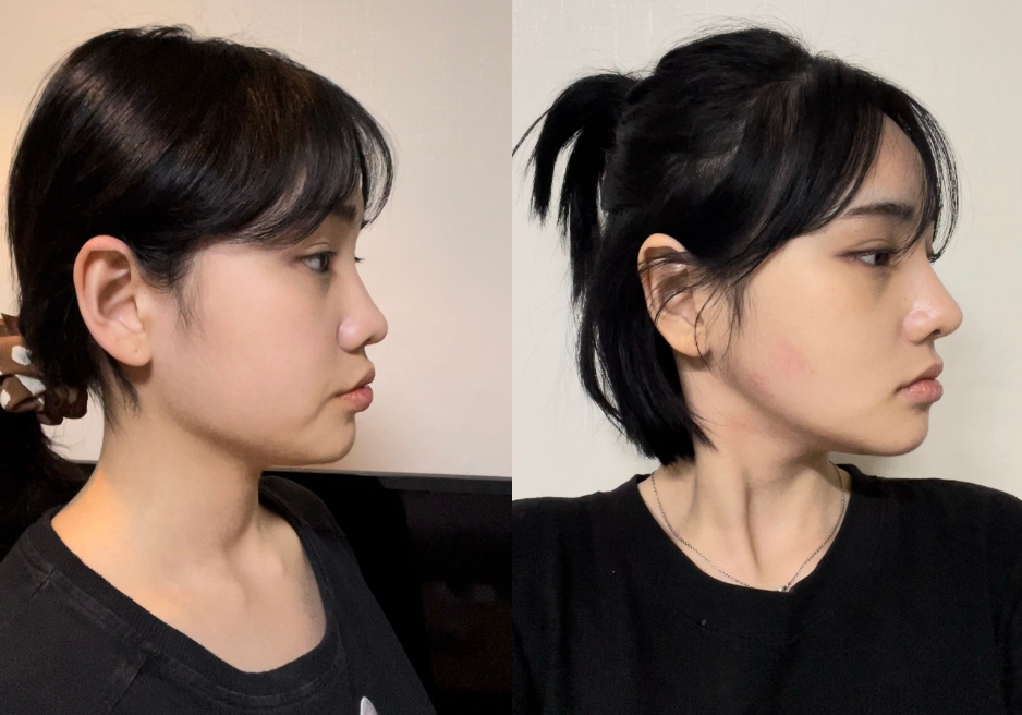 韩国鼻子手术