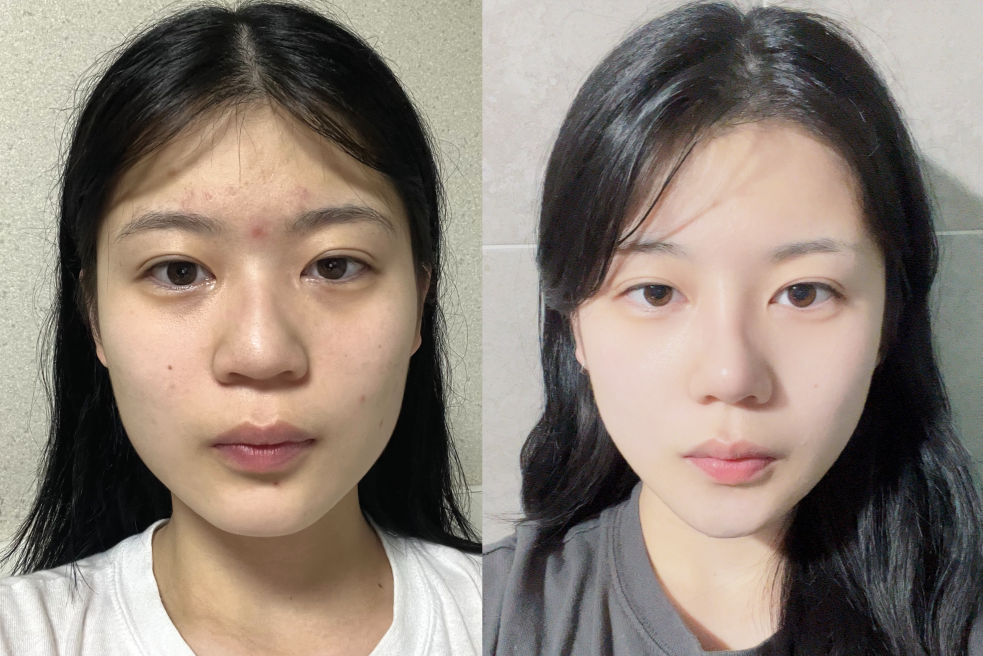 韩国 AB 整形外科医院鼻翼切除术