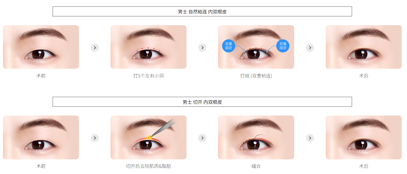 男性内侧双眼皮手术