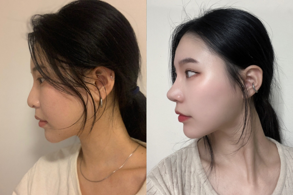 韩国鼻部整形手术前后对比