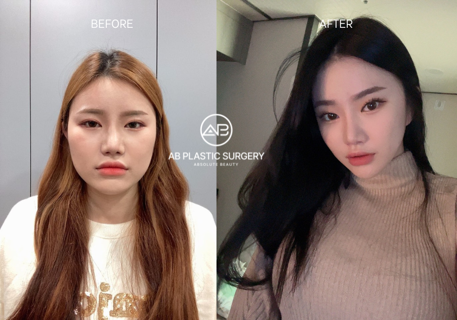 韩国面部轮廓手术