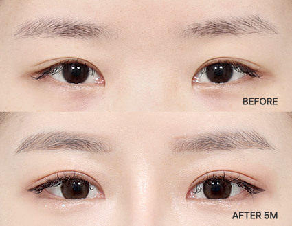 韩国眼部修复手术