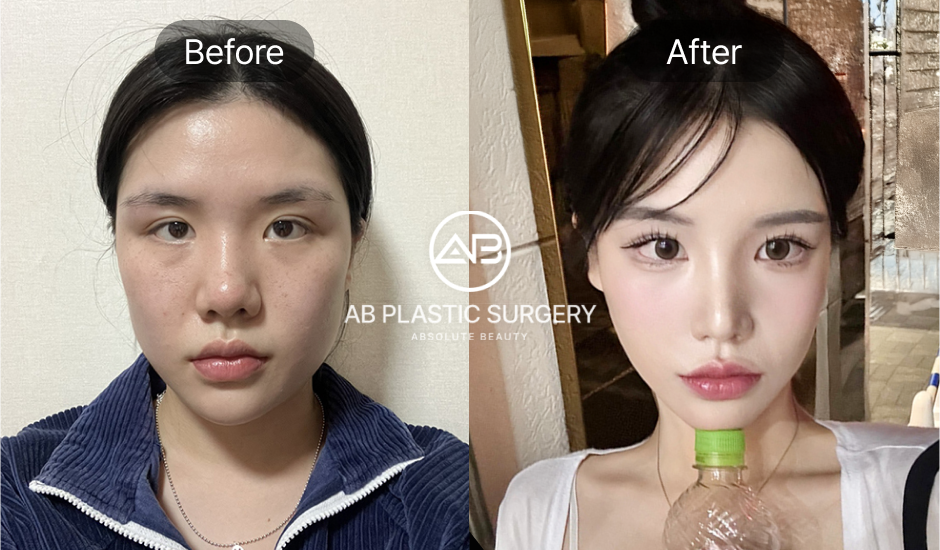 輪廓手術術前術後真實評價照片