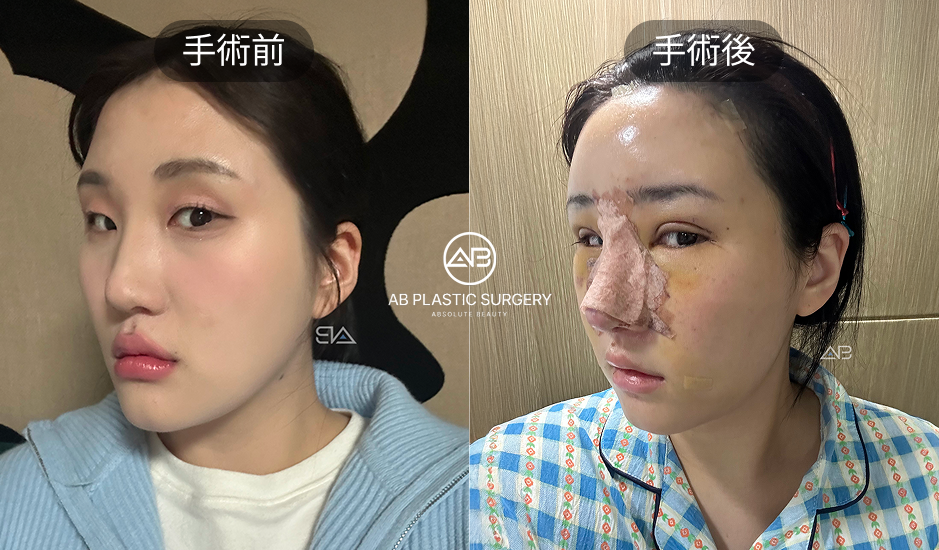 韓國小翹鼻整形術後腫脹與瘀青案例,AB整形外科恢復期實拍照片