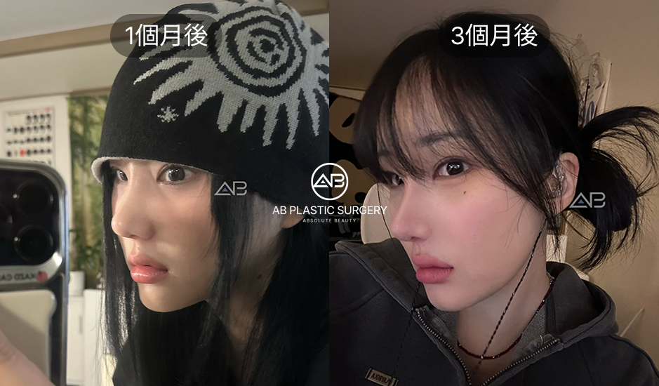 韓國小翹鼻整形術後1至3個月穩定期案例,鼻尖自然柔和效果展示