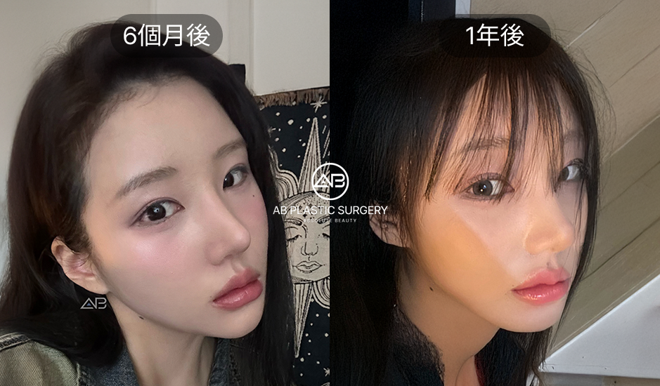 韓國小翹鼻整形術後6個月完全恢復案例,鼻尖線條自然持久效果展示