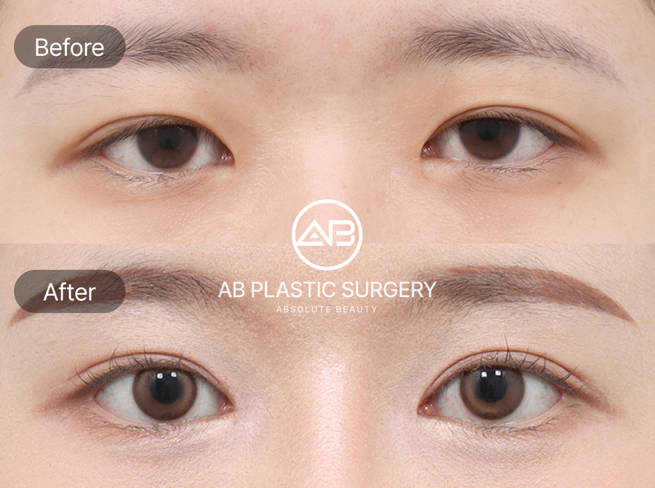 杏眼雙眼皮手術前後對比圖，透過開眼頭與雙眼皮手術改善單眼皮，使眼型更接近杏眼比例，眼神更有神采