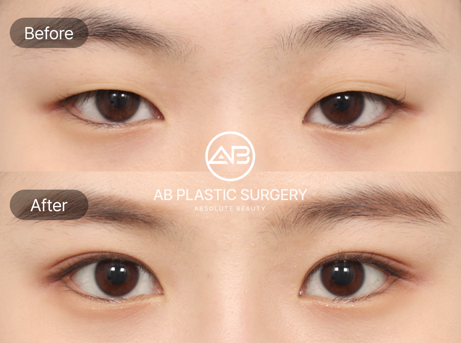 杏眼手術前後對比圖，透過雙眼皮與開眼頭改善下垂或銳利的眼型，使眼神更柔和自然，展現東方典型杏眼之美