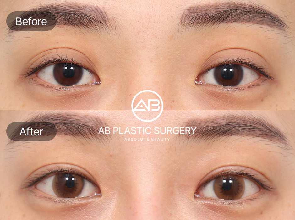 杏眼雙眼皮手術前後對比圖，透過切開法與埋線法改善眼型，去除多餘脂肪或固定自然摺痕，使眼神更明亮立體，為杏眼塑形打下基礎