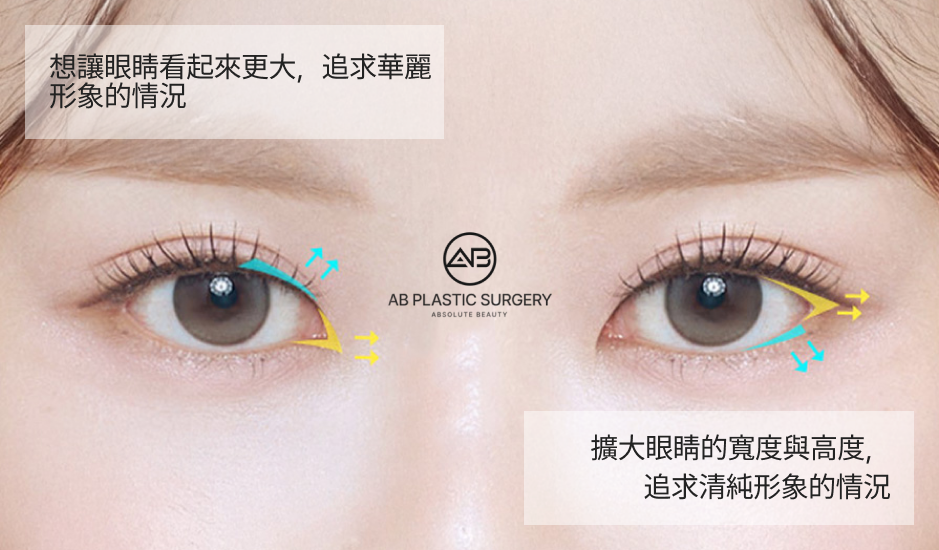 開眼頭手術與雙眼皮手術複合效果示意圖，改善內眥贅皮與眼距過寬，使眼睛更修長集中，打造自然杏眼，韓國AB整形外科