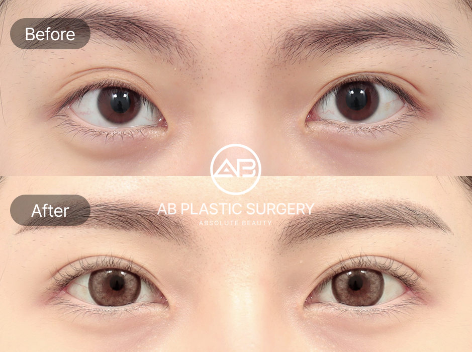 杏眼手術前後對比照片，展示雙眼皮與開眼頭後眼神更集中自然，韓國AB整形外科真實案例