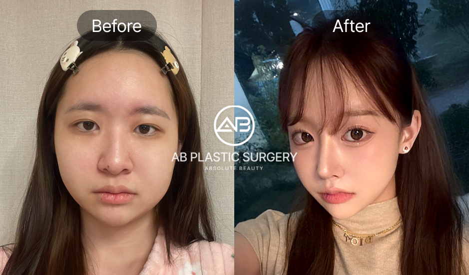韓國AB整形外科 V臉手術 前後對比