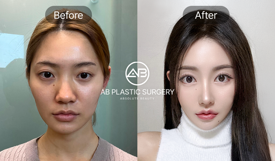 韓國AB整形外科 寬臉削骨 前後對比｜下顎角削骨 顴骨內推