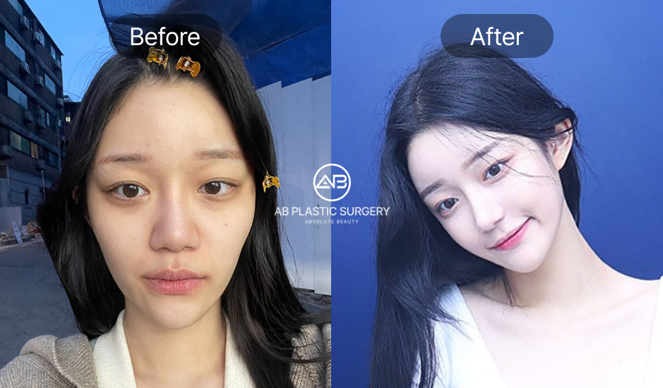 韓國醫美診所前後對比照