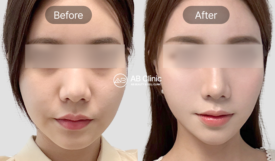 AB皮膚科 電波拉提與音波拉提臉部緊緻效果｜下頜線改善｜小臉前後對比照