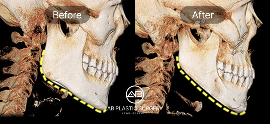 韓國AB整形外科 V-Line削骨 3D-CT 前後對比｜下顎角改善