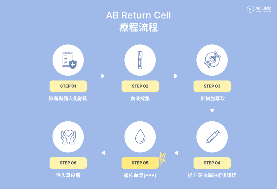 AB 幹細胞水光針施作流程示意圖，依序說明診斷諮詢、血液採集、幹細胞萃取、精準注射與血漿塗佈及術後護理等完整療程步驟