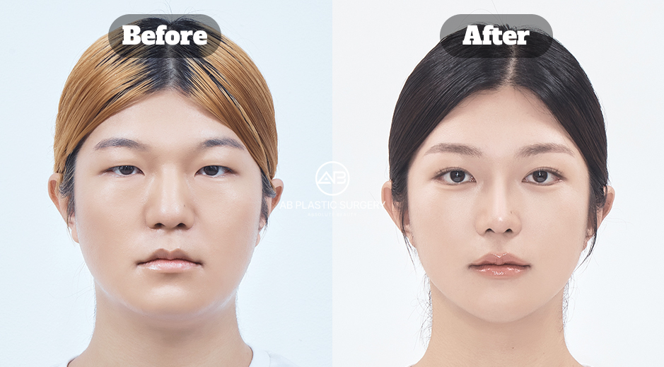 輪廓結構與皮膚狀態並行改善的整合型美容療程前後對比案例