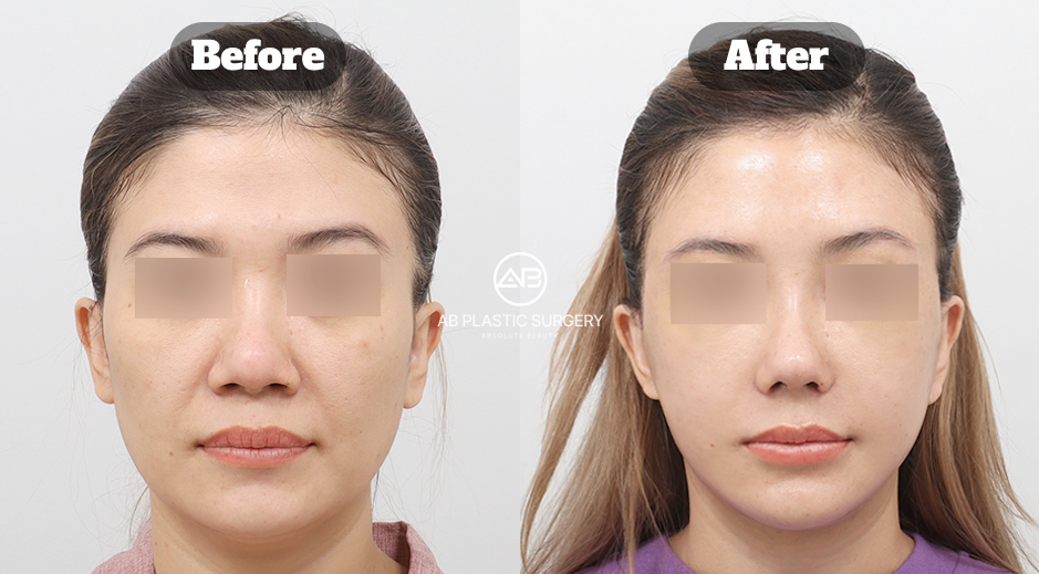 幹細胞再生醫美療程前後肌膚狀態改善對比案例