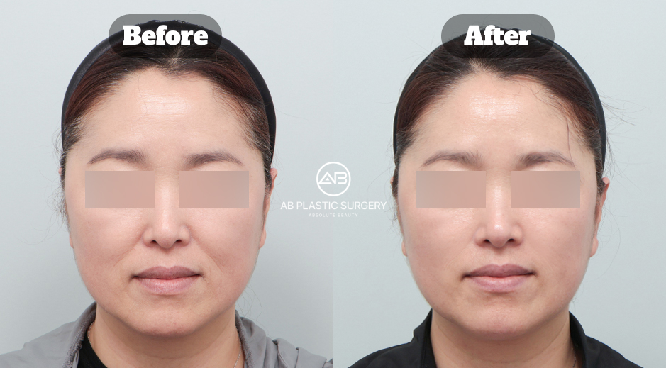 整合型皮膚科抗老化療程前後肌膚狀態改善對比案例