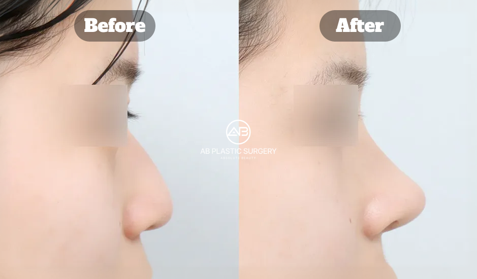 韓國駝峰鼻與蒜頭鼻整形前後比較影像