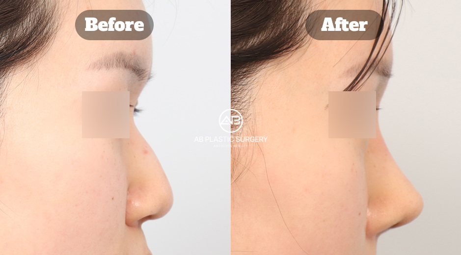 韓國駝峰鼻整形前後改善案例回顧