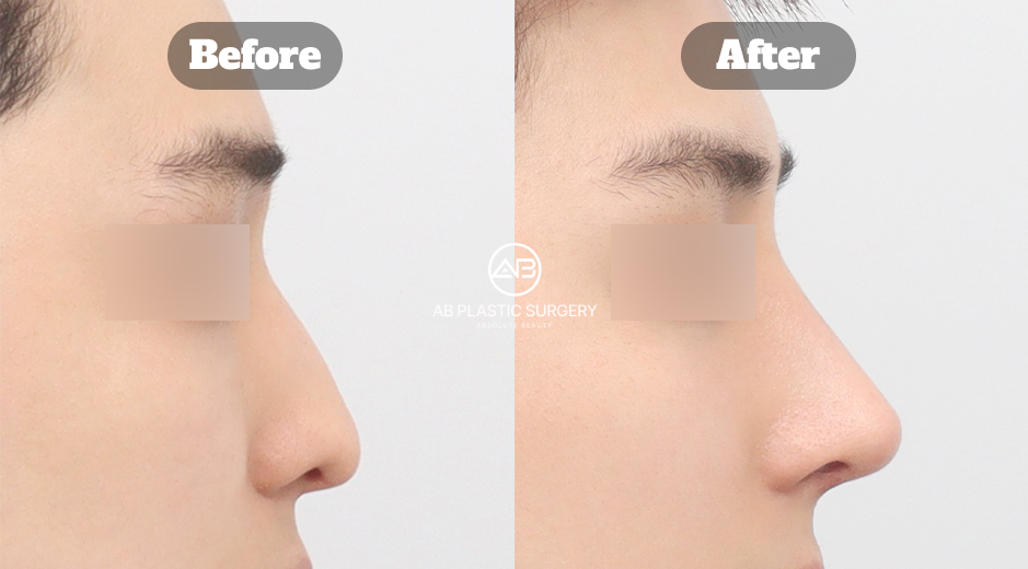 韓國男性駝峰鼻、功能性鼻整形與自體肋軟骨隆鼻前後案例回顧