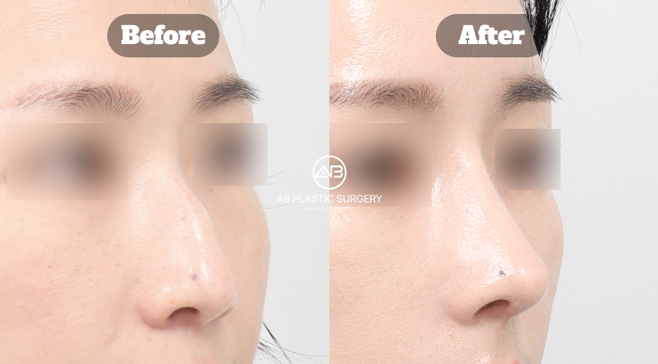 韓國AB整形外科隆鼻與蒜頭鼻整形前後結果影像