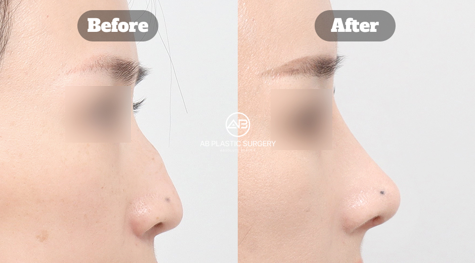 韓國女性蒜頭鼻與駝峰鼻整形前後結果影像