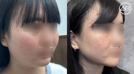 【轮廓三件套+咬肌缩小+面部吸脂】 术后7个月【真实后记】